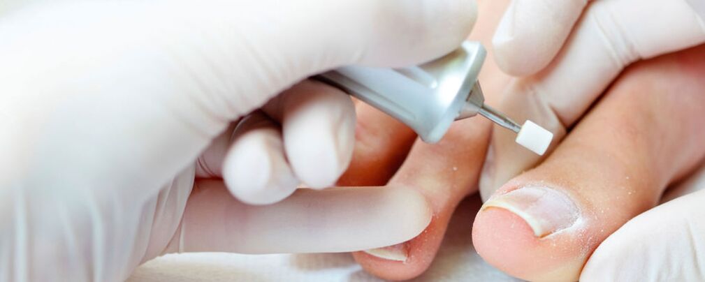 Cutting the top layer of the nail