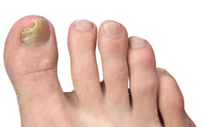 Fungus on the thumb of the foot