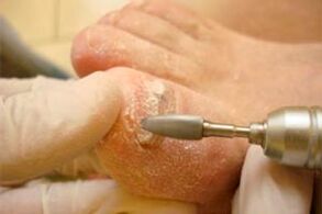 Mechanical cutting of the nail plate