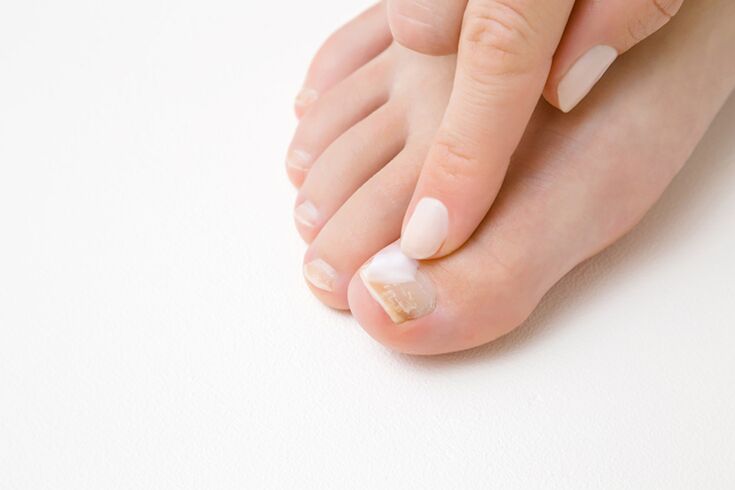 Finger treatment with ointment from the fungus