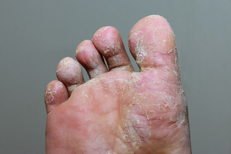 Severe stage of finger skin mycosis