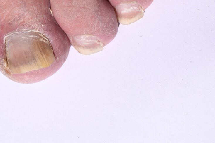 The initial stage of mycosis of nails on the legs