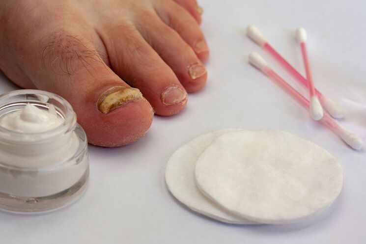 Treatment of fingers fungus with cream from the fungus