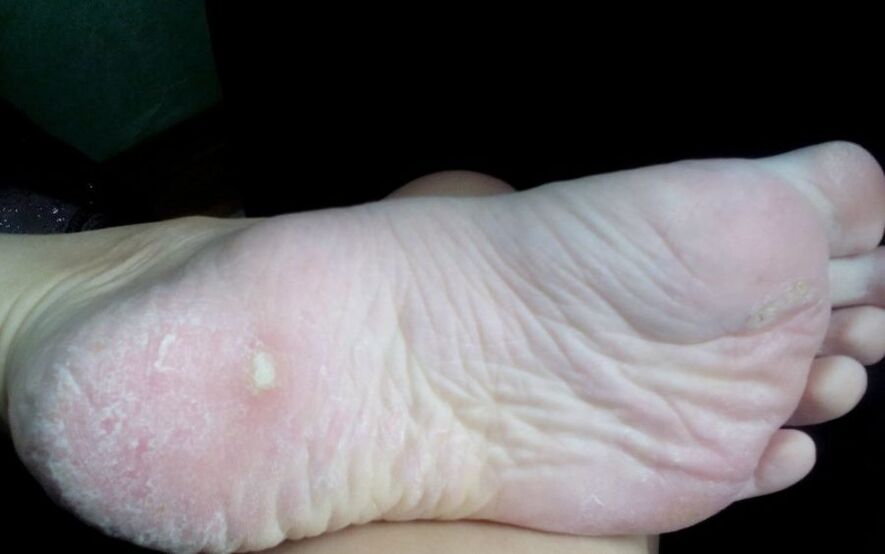 How the fungus looks and manifests itself