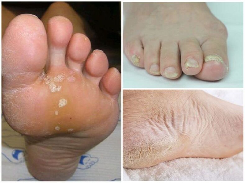 Symptoms of mycoses