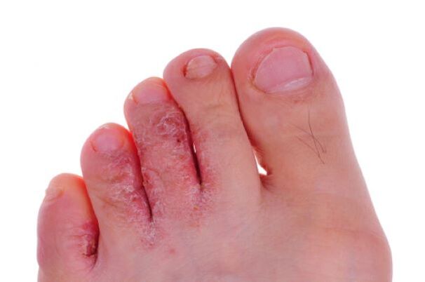 fungal disease of toes