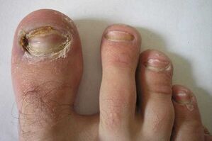 damage to the nail plates on the toes due to a fungal infection