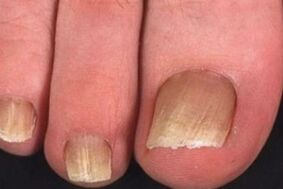 fungal infection of toenail