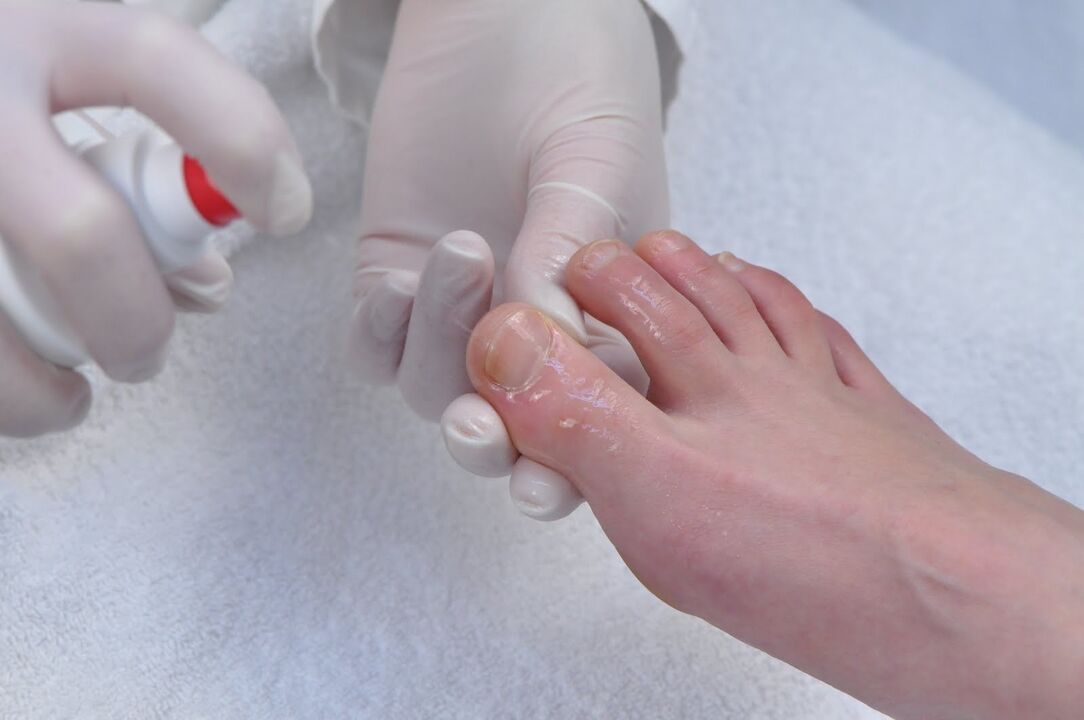 treatment of toenails for fungus