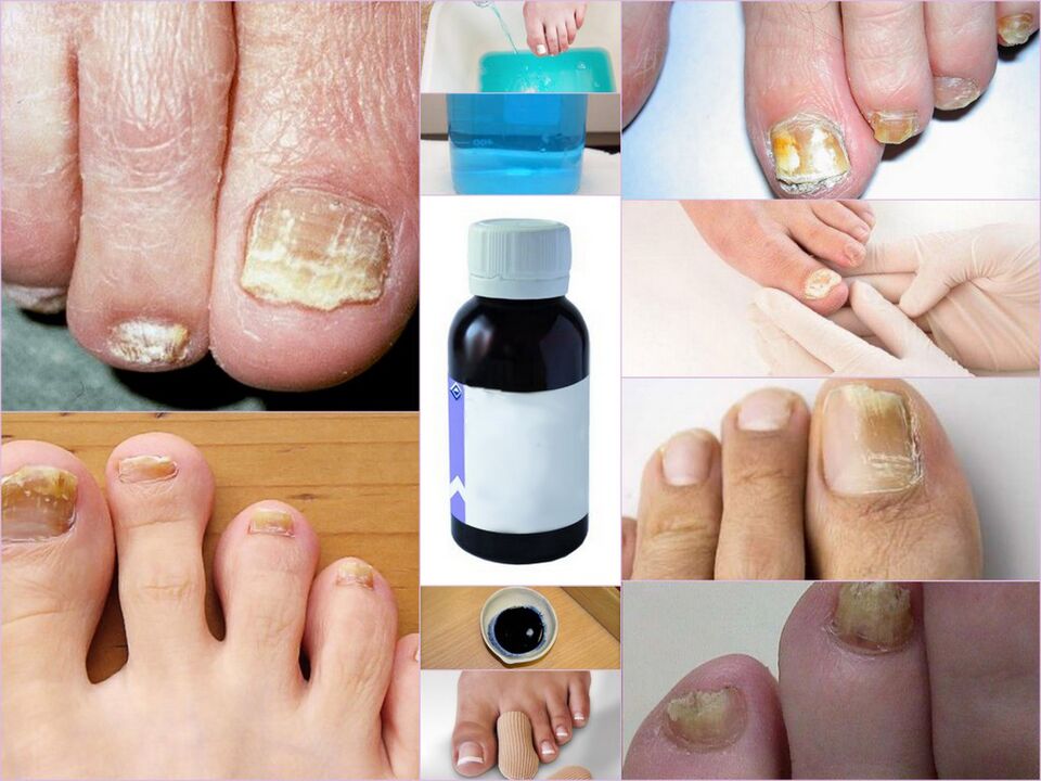 medicines for toenail fungus