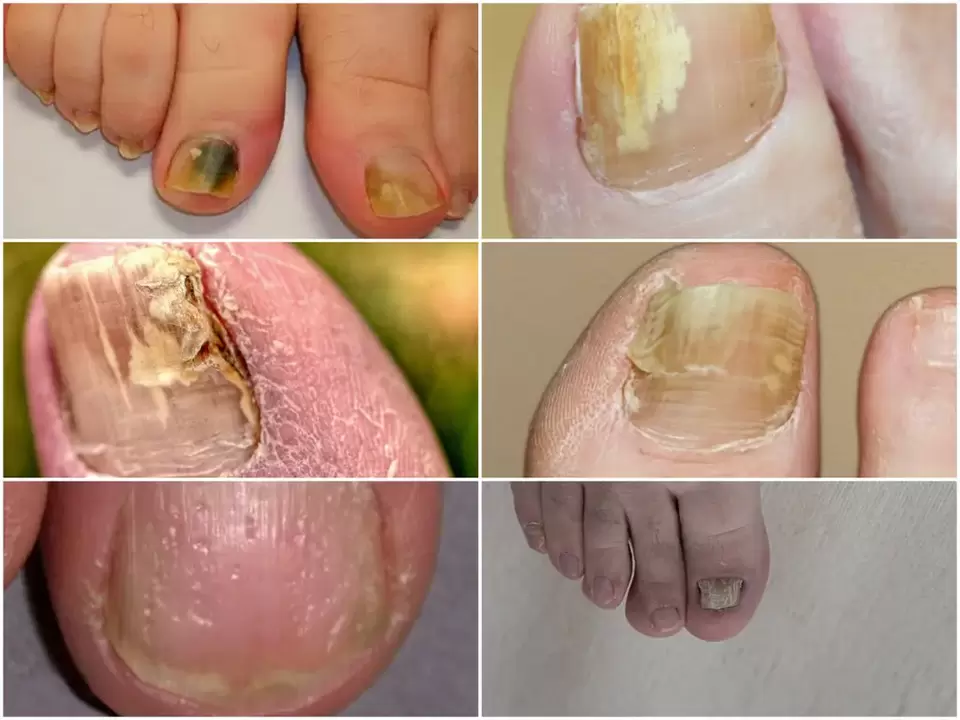 Symptoms of onychomycosis - changes in the color and structure of nails