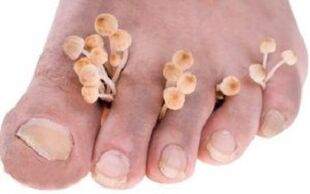 Onychomycosis of toenails