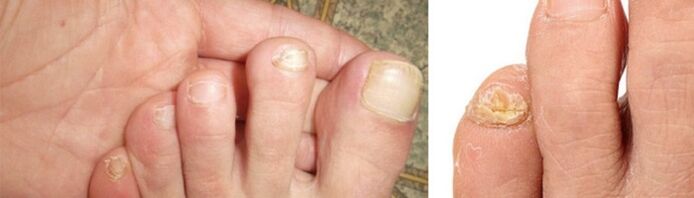 photo of manifestations of fungus on toenails
