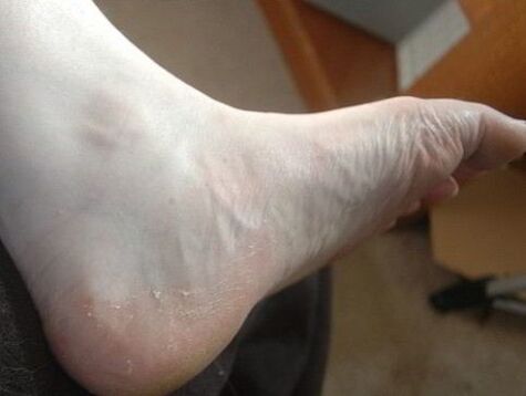 peeling of the foot of the leg as a sign of fungal infection